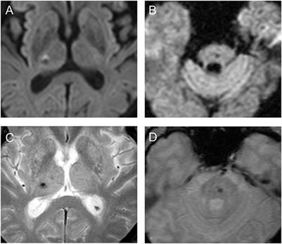 Cerebral Microbleeds in the Patients With Acute Stroke Symptoms